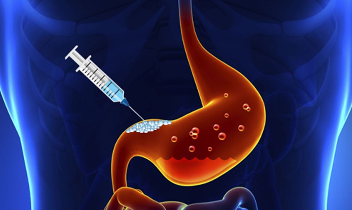 دارو و بوتاکس معده درمان چاقی نیستند/ تغییر سبک زندگی؛ مؤثرترین راه مقابله با چاقی
