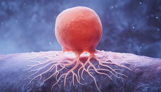 آخرین وضعیت شایع ترین سرطان زنان در ایران/ سرطان سینه؛ شایع‌ترین سرطان