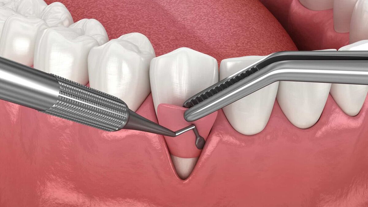 راهکار نانویی برای تسریع ترمیم و کاهش خطر عفونت جراحی دندان