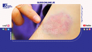 فیلم | این علامت در پوست نشانه قند خون بالاست