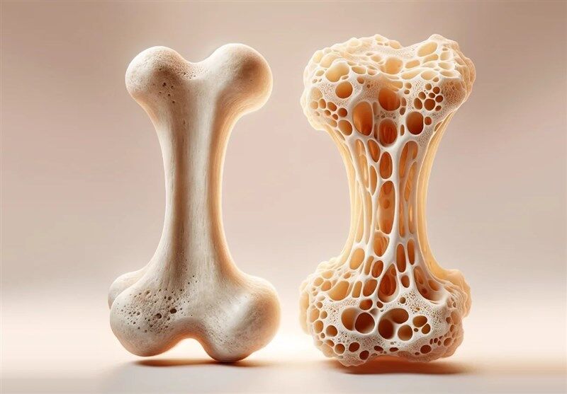 شیوع ۸۰درصدی مشکلات استخوانی در ایرانیان بالای ۵۰سال/ ۶۳درصد سالمندان کلسیم کافی مصرف نمی‌کنند