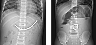 خارج کردن ۱۰۰ آهنربا از روده نوجوان ۱۴ ساله