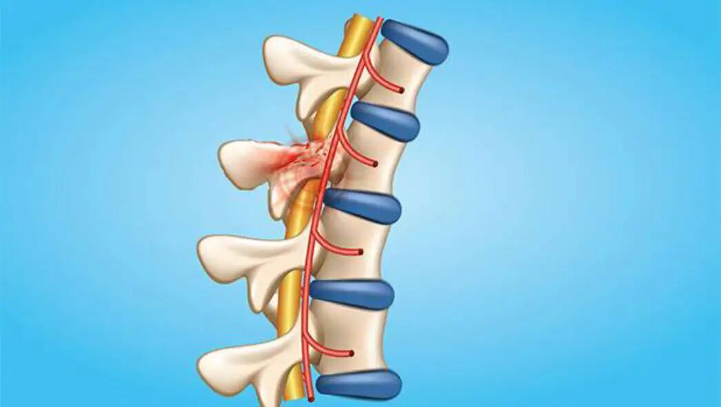 تحریک طناب نخاعی، افق تازه در درمان دردهای مزمن است