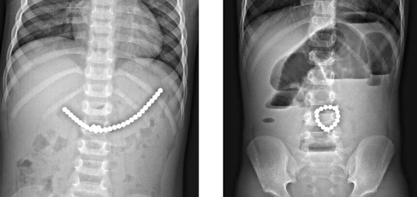 خارج کردن ۱۰۰ آهنربا از روده نوجوان ۱۴ ساله