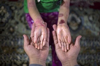 بیماری پروانه‌ای نتیجه جهش ژن در ازدواج های فامیلی است