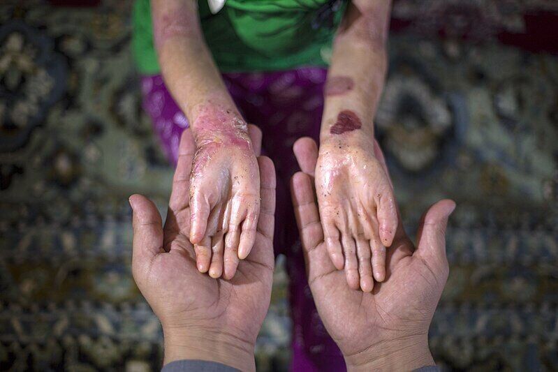 بیماری پروانه‌ای نتیجه جهش ژن در ازدواج های فامیلی است