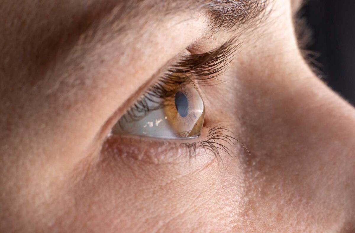 V Iranu je pojavnost keratokonusa višja kot v svetu