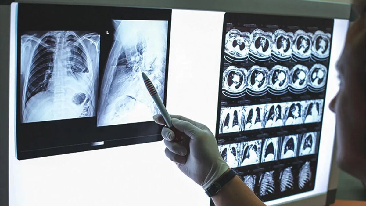 پوشش درمان سل در ایران بیش از ۸۰درصد است/ مشکل دسترسی به تجهیزات و دارو با اعمال تحریم‌ها