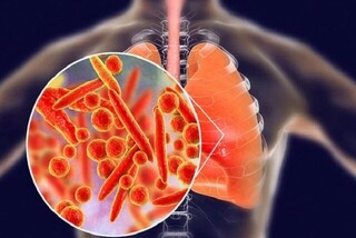 پنومونی؛ همچنان بزرگ‌ترین قاتل عفونی جهان / ضرورت تقویت واکسیناسیون برای مهار مرگ‌ومیر ذات‌الریه