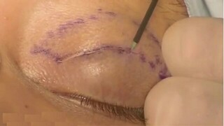 بلفاروپلاستی ظاهر چشم را تغییر نمی‌دهد؛ فقط جوان‌تر می‌کند