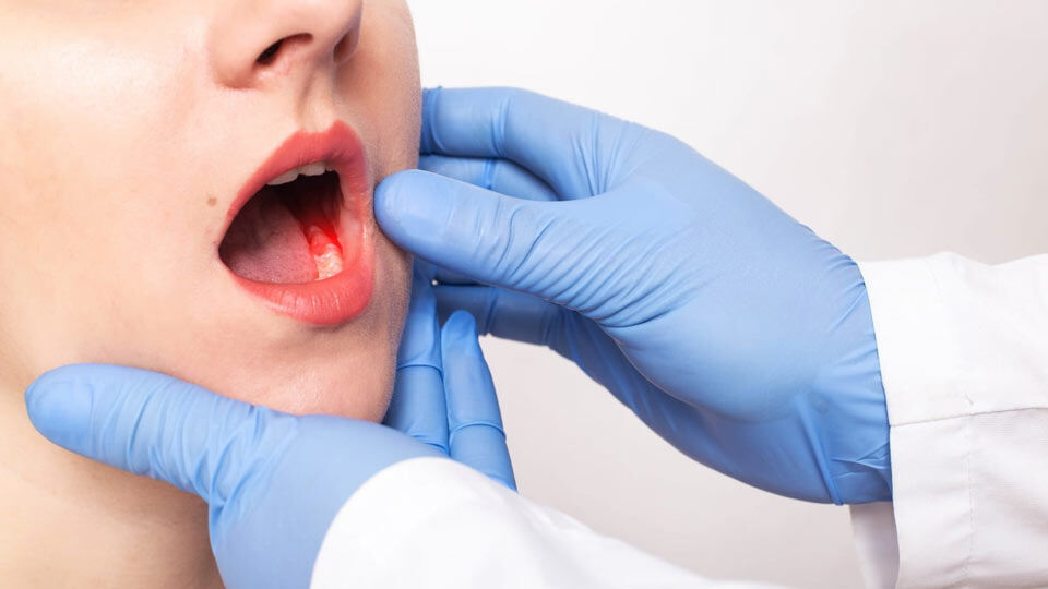 افزایش سرطان دهان در ایران/ مبتلایان به ویروس اچ پی وی در صدر هستند