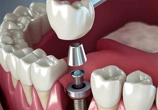 تبلیغ ایمپلنت فوری دروغ است / سلبریتی‌ها حق تبلیغ خدمات پزشکی را ندارند