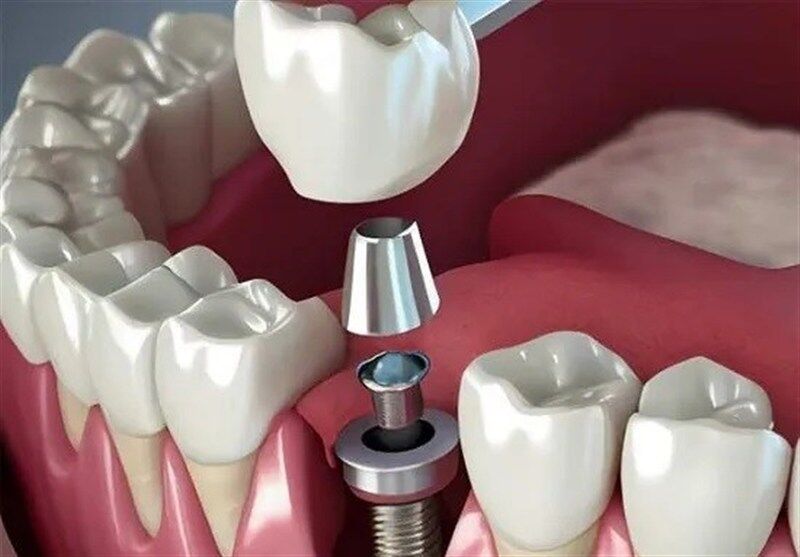 تبلیغ ایمپلنت فوری دروغ است / سلبریتی‌ها حق تبلیغ خدمات پزشکی را ندارند