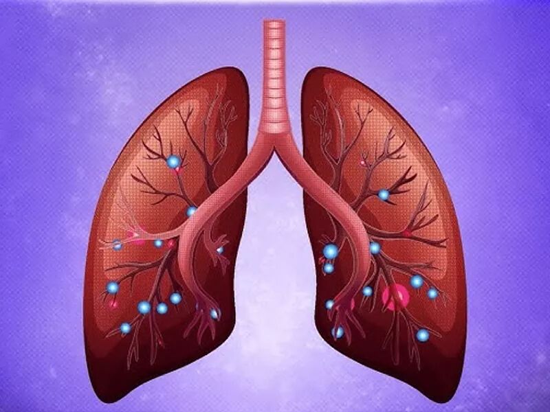 دانستنی‌ها و اقدامات لازم درباره درد ریه