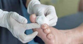 ارائه خدمات رایگان پلاسما درمانی به بیماران دیابتی در کرج