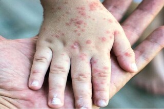 ثبت ۷۱۴ مورد «سرخک» در کشور؛ اوج ابتلا در اردیبهشت