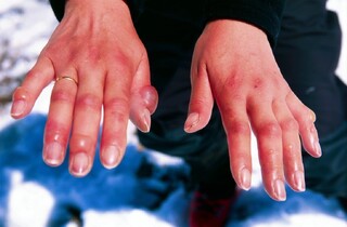 سرمازدگی در کمین است؛ خودتان را اینطور محافظت کنید