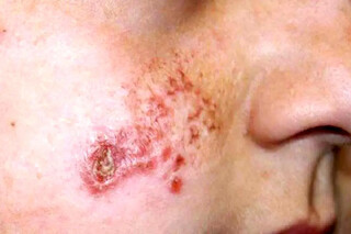 هشدار درباره شیوع ‌انگل‌ خطرناک لیشمانیوز