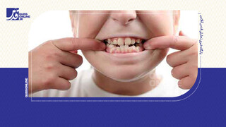 فیلم | چرا دندان‌ها نامرتب می‌شوند؟