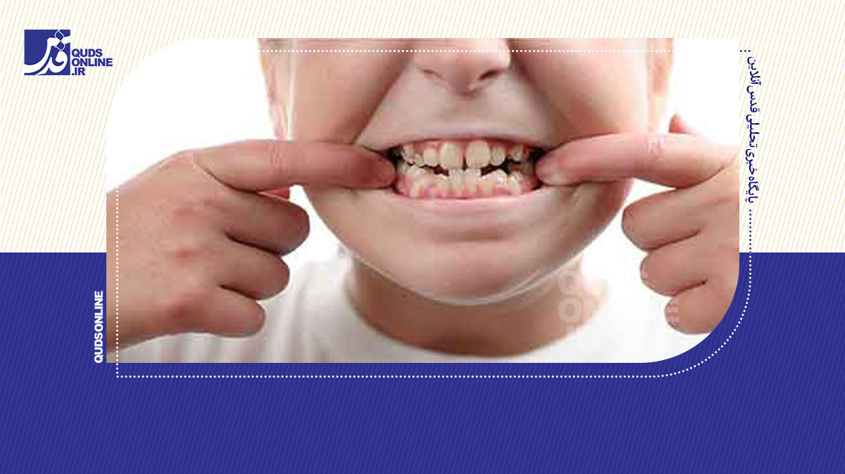 فیلم | چرا دندان‌ها نامرتب می‌شوند؟