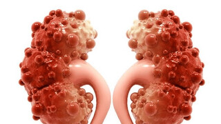 زنان این بیماری را جدی بگیرند