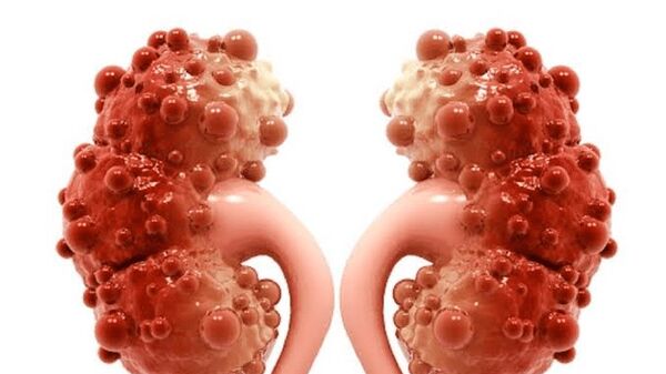 زنان این بیماری را جدی بگیرند