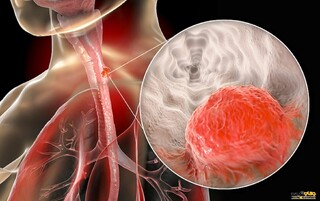 چند نکته مهم درباره سرطان مری