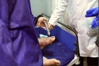 پلاسما درمانی ۱۵۰۰ بیمار مبتلا به زخم دیابتی در کرج