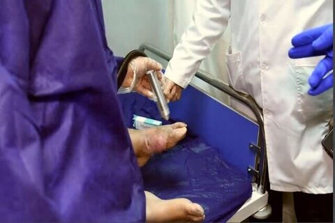 پلاسما درمانی ۱۵۰۰ بیمار مبتلا به زخم دیابتی در کرج