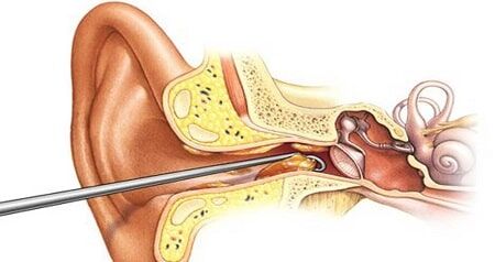 آیا جرم‌گیری گوش موجب بد عادتی می‌شود؟