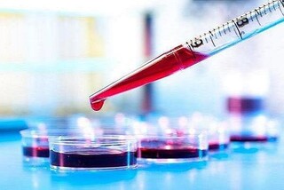 پیش بینی بیماری کرون  با یک آزمایش خون ساده