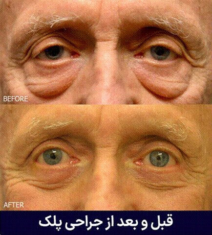 آشنایی با عمل جراحی پلک و مزایا و عوارض آن